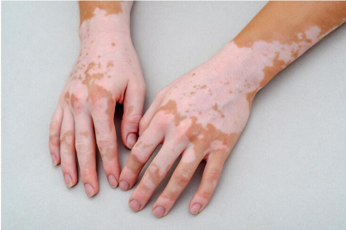 Vitiligo hand