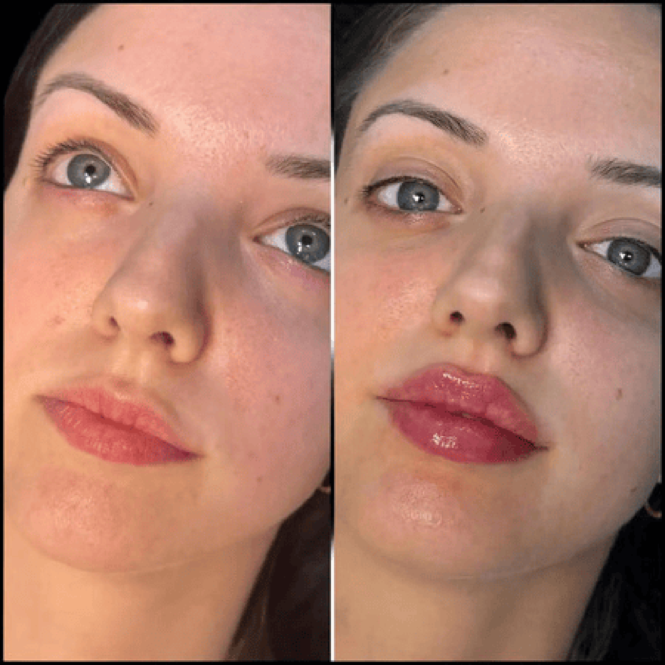 Fillers Doctors in dubai
