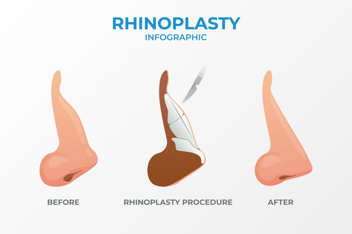 rhinoplasty in Jaipur