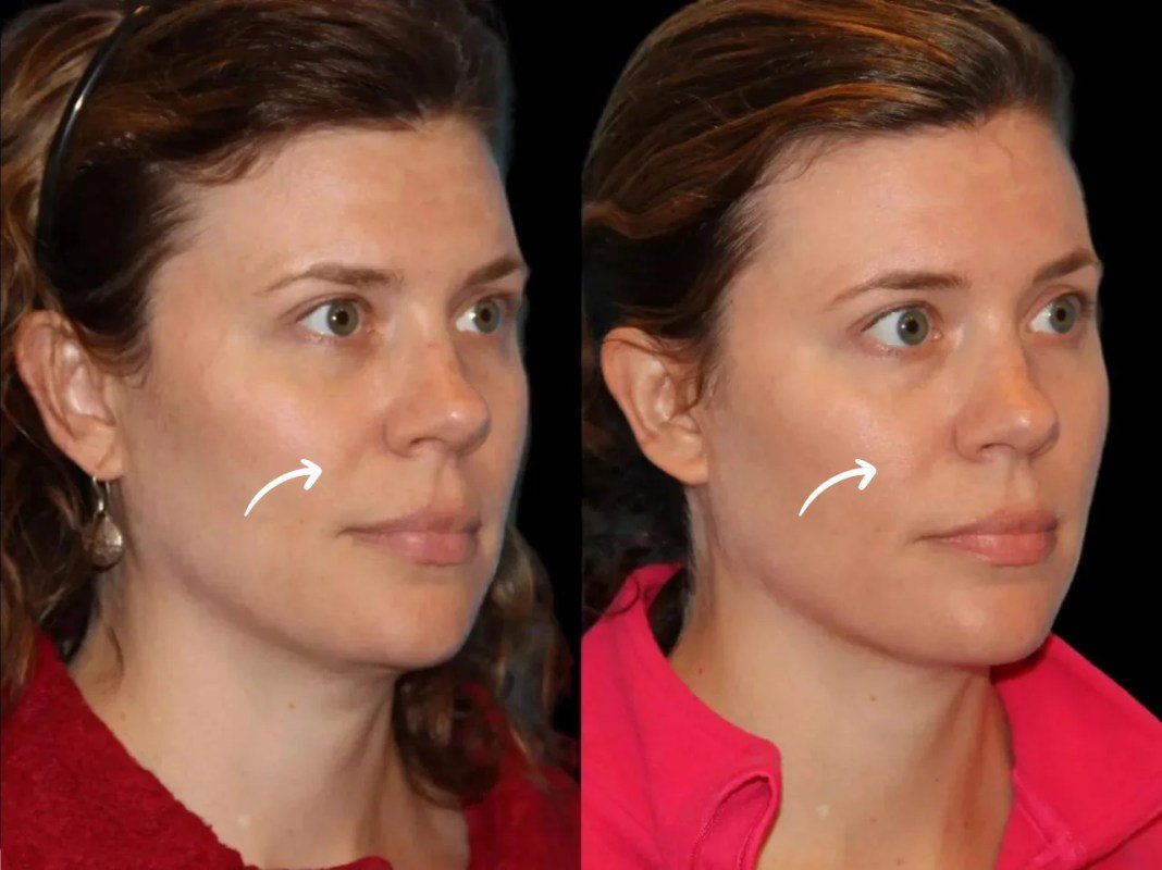 sculptra in dubai