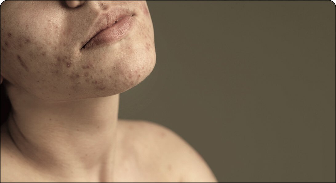 acne treatment