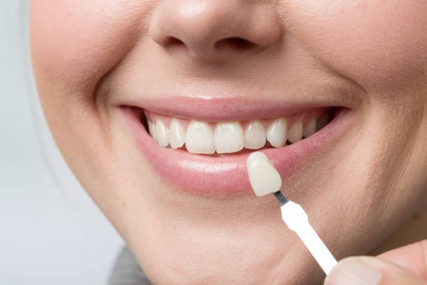 What to Expect on the Day of Your Procedure Dental Veneers in Islamabad Pakistan: